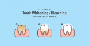 Denver Teeth Whitening